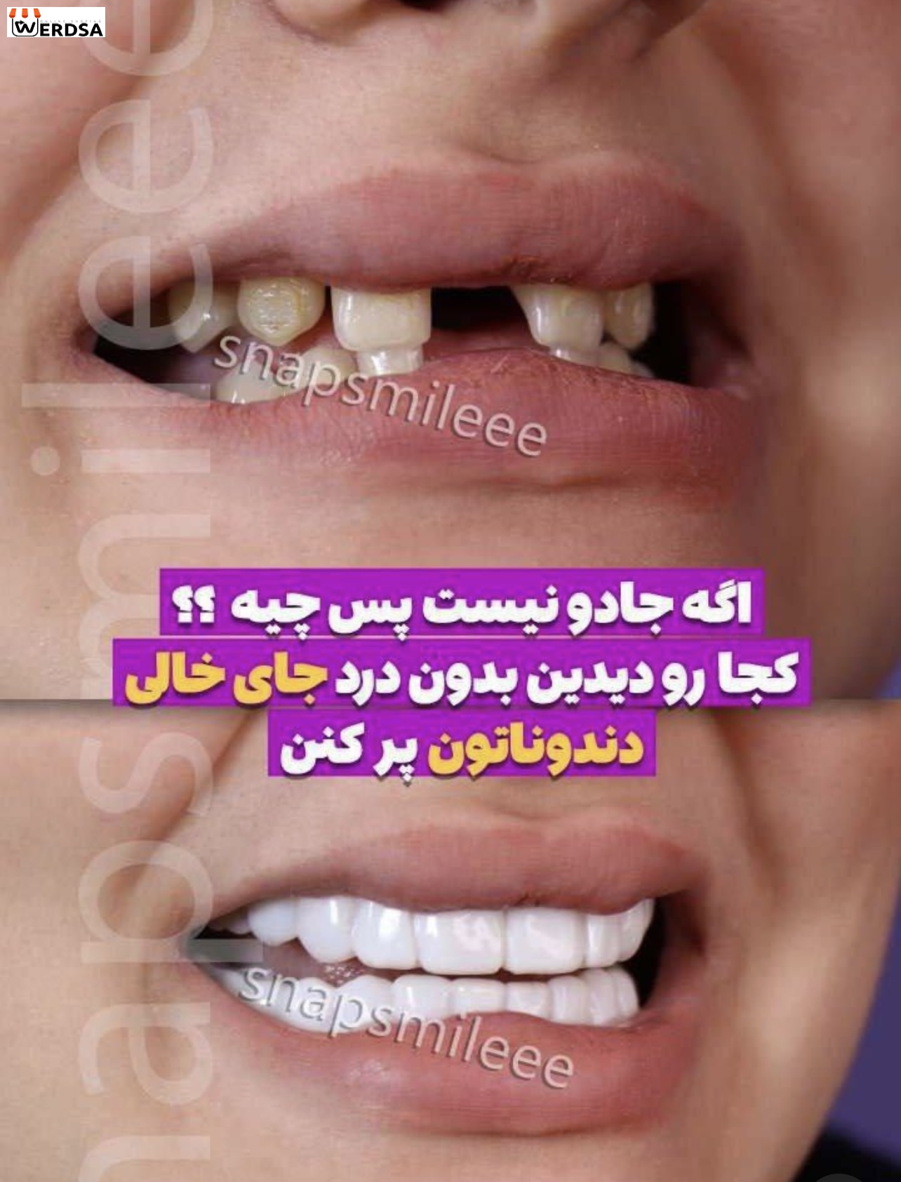 اسنپ آن اسمایل دندان فک بالا و پایین با مشاوره رایگان